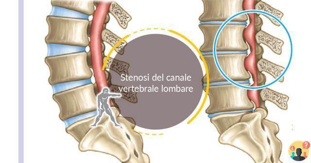 ¿Ejercicios para el estrechamiento (estenosis) del canal espinal?