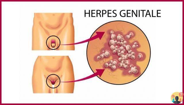 Herpes genital cuando preocuparse?
