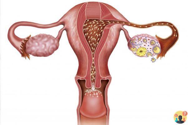 ¿Cómo se forman las úlceras del útero?