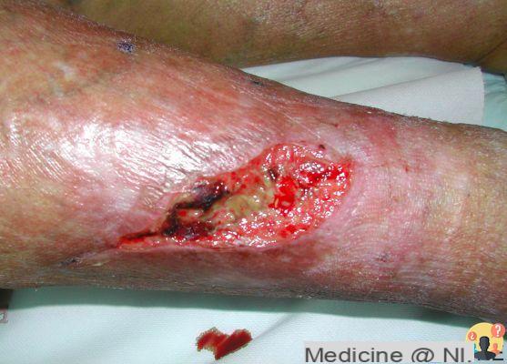 ¿Qué es la úlcera varicosa?