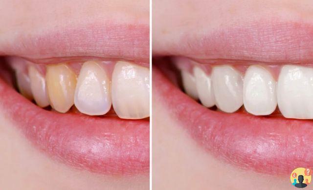 ¿Cómo deshacerse de las manchas marrones de los dientes?