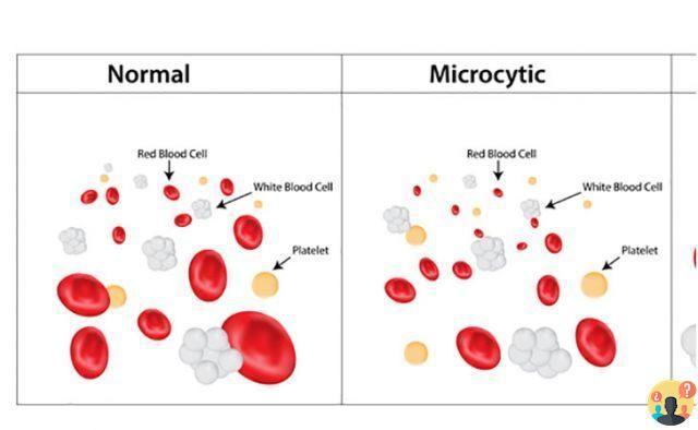 ¿Qué es la microcitosis de los glóbulos rojos?
