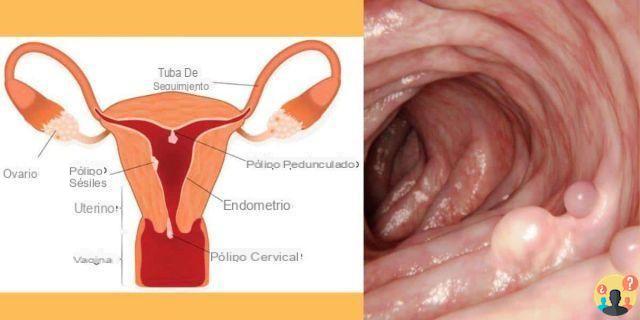 ¿Pólipos uterinos en la menopausia?