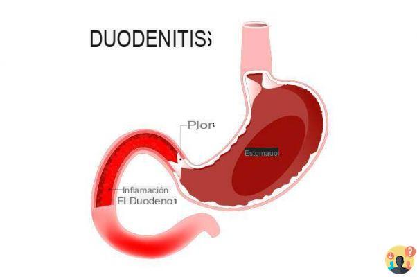 ¿Cuáles son los síntomas de la duodenitis?