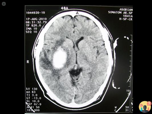 ¿Cuáles son los síntomas de un hematoma en la cabeza?