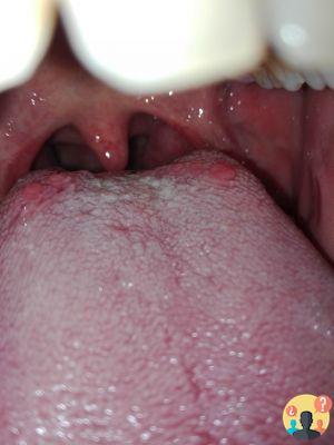 ¿Inflamación en la base de la lengua?
