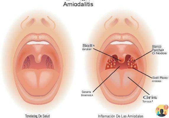 ¿Cuándo deja de ser contagiosa la amigdalitis?