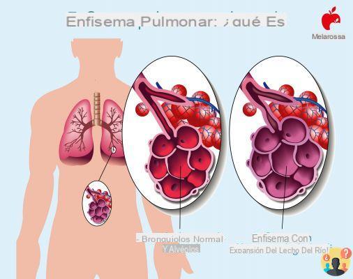 ¿Cómo se muere uno de enfisema pulmonar?