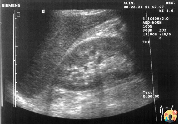 Ultrasonido intestinal ¿Qué se puede ver?