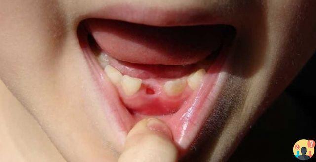 ¿Qué significa cuando sueñas que se te cae un diente?