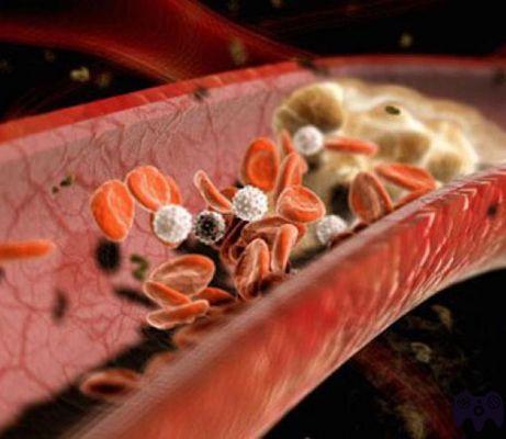 ¿Cómo limpiar las arterias de placas?