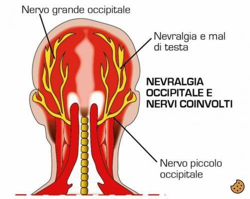 ¿Qué es la Neuralgia de Arnold?