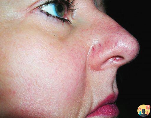 ¿Cómo fortalecer los capilares de la nariz?