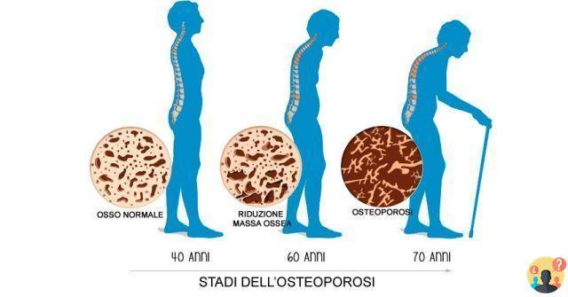 ¿Cuál es la diferencia entre osteopenia y osteoporosis?