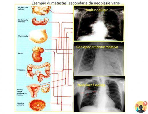 ¿Cómo se tratan las metástasis pulmonares?