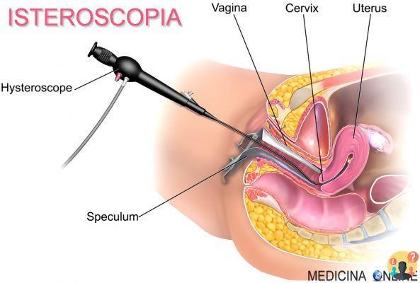 Histeroscopia quirúrgica pagada ¿cuánto cuesta?