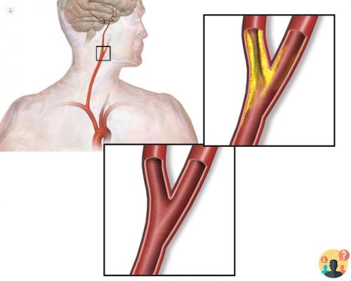 ¿Qué es la arteria carótida?