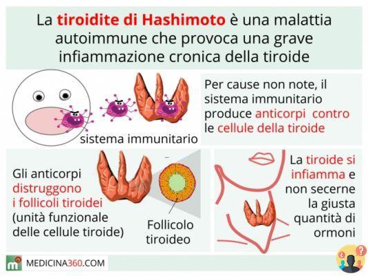 ¿Quién cura la tiroiditis de Hashimoto?