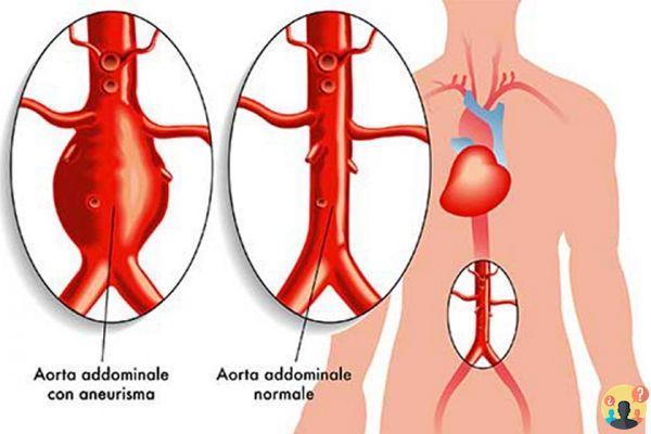 ¿Cuándo operar un aneurisma de aorta abdominal?