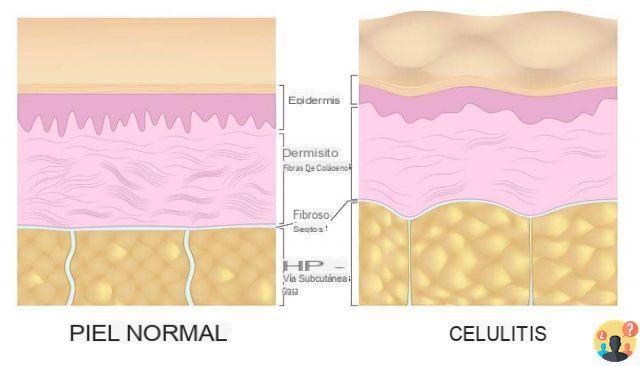 ¿A qué se debe la celulitis?