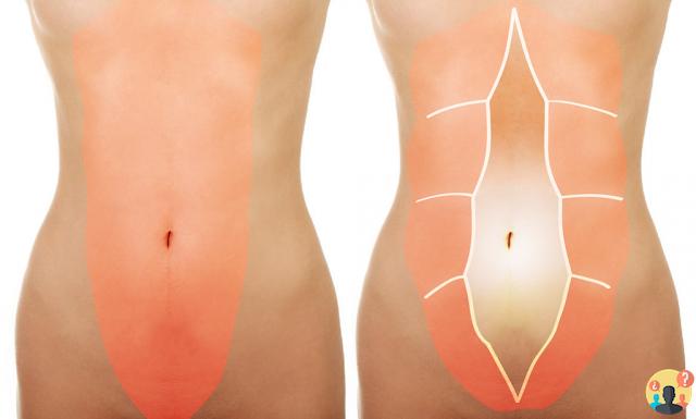 ¿Qué es la diástasis del recto abdominal?