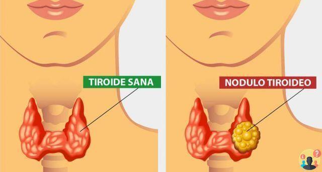 ¿Cuáles son los síntomas de un bulto en la tiroides?