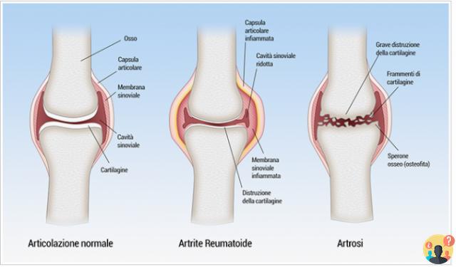 ¿Diferencia entre artritis y artrosis?