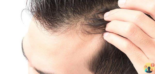 ¿Qué es el retroceso fisiológico de la línea del cabello?