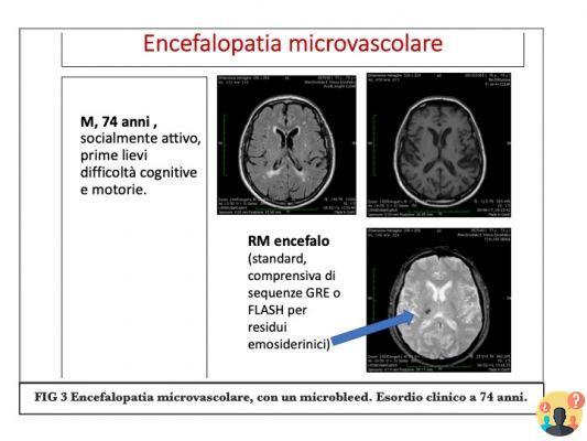 ¿Qué es la encefalopatía vascular crónica?