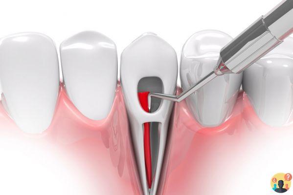 ¿Coste para desvitalizar y reconstruir un diente?