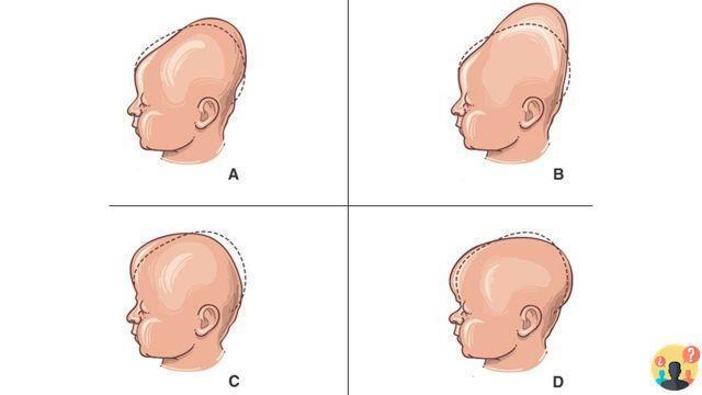 ¿Bebés que nacen con la cabeza alargada?