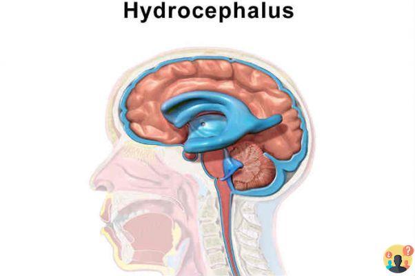 ¿Causas de la hidrocefalia en adultos?