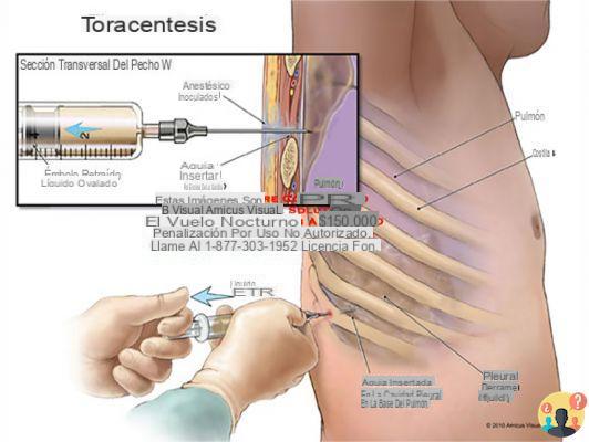 ¿Cómo se hace la toracocentesis?