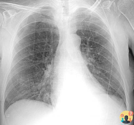 ¿Acentuación difusa del patrón pulmonar bilateralmente en ausencia de lesiones?