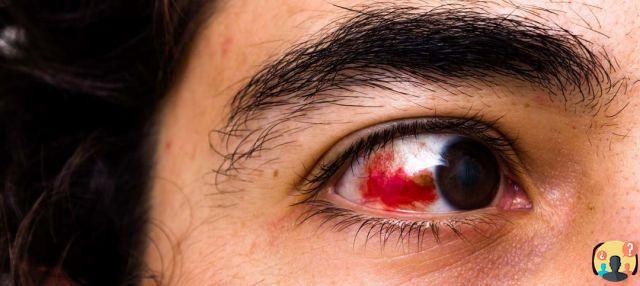 ¿Coágulo de sangre en el ojo?
