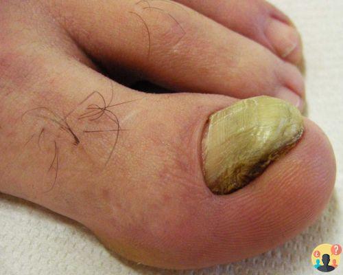¿Dedo gordo del pie con uña engrosada?