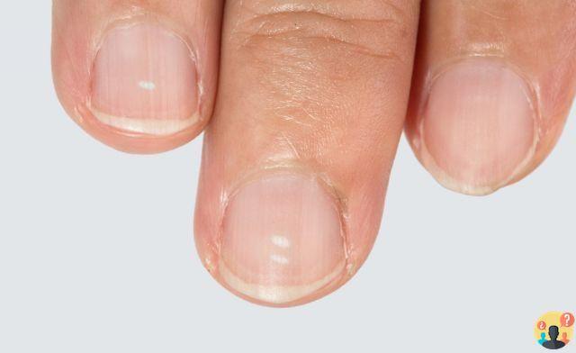 ¿Qué son los puntos blancos en las uñas?