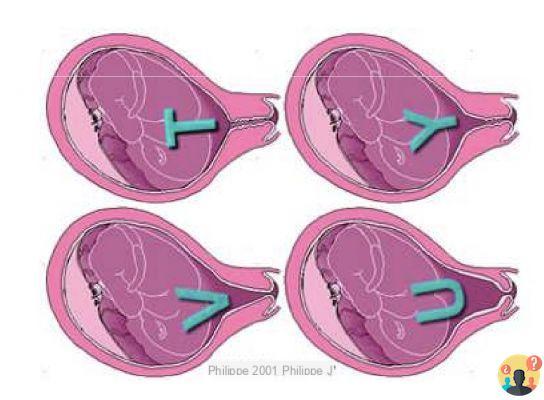 ¿Cómo se acorta el cuello uterino?