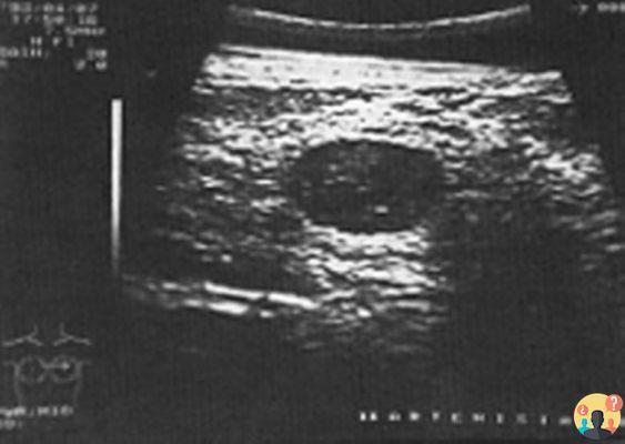 ¿Área mamaria hipoecogénica con márgenes irregulares?