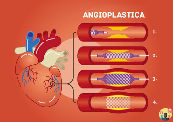 ¿Cuándo es la angioplastia o el bypass?