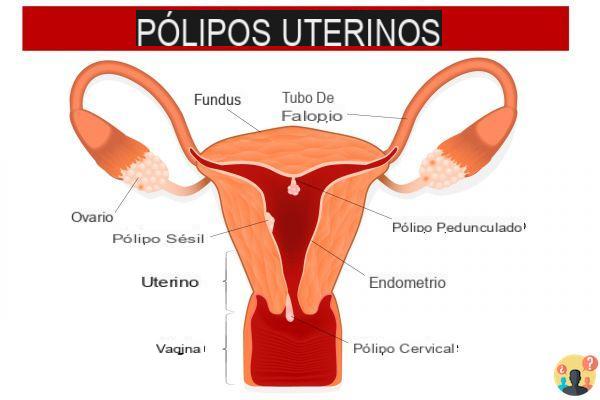 ¿Colgajos polipoides de endometrio secretor?