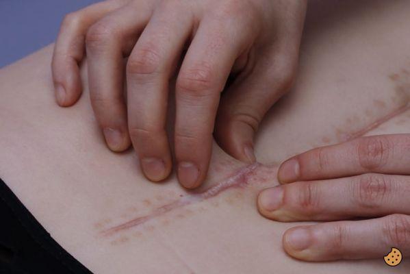 ¿Qué es el desprendimiento de una cicatriz?