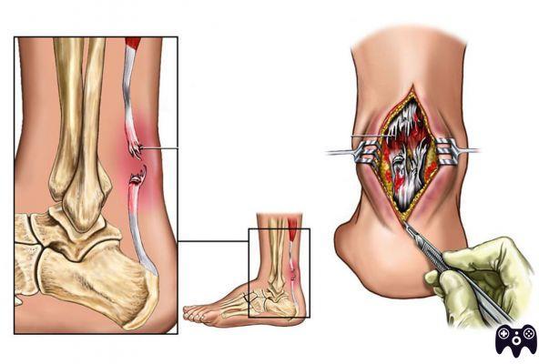 ¿Tiempo de curación de la lesión del tendón del pie?