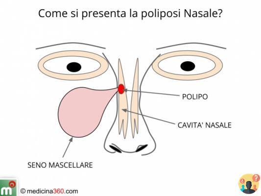 Poliposis nasal ¿Qué alimentos evitar?