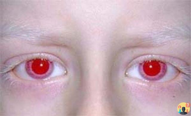 ¿Ojos rojos por albinismo?