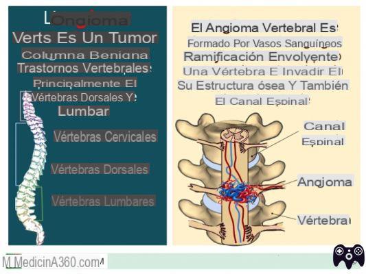 ¿Qué es el angioma vertebral?