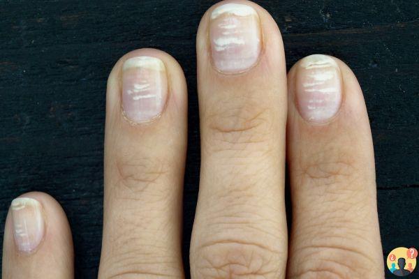 ¿Remedios para la leuconiquia con esmalte de uñas?