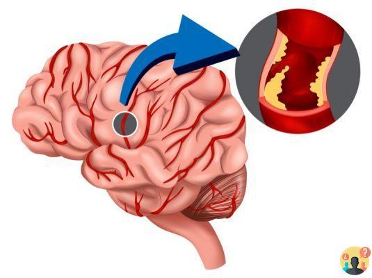 ¿Qué daños provoca una lesión cerebral grave?