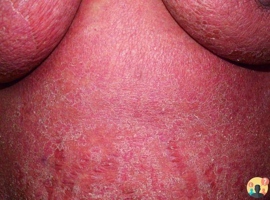 ¿Qué es la dermatitis exfoliativa?