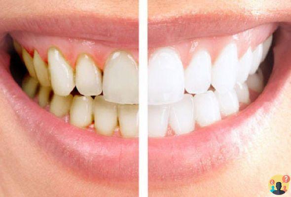 ¿Se pueden quitar las manchas con la limpieza dental?